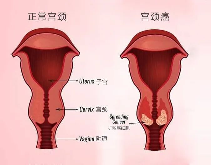 陈胖胖哦|宫颈不是“哑巴器官”,请注意它给你身体的几个提示!