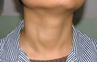 甲状腺|转告家人：这种“粗粮”吃不得，比烟酒还毁甲状腺，赶紧扔