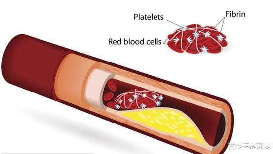穴位|天然“溶栓能手”被发现，不是山楂，每天吃一点，血管通畅，告别头晕手麻