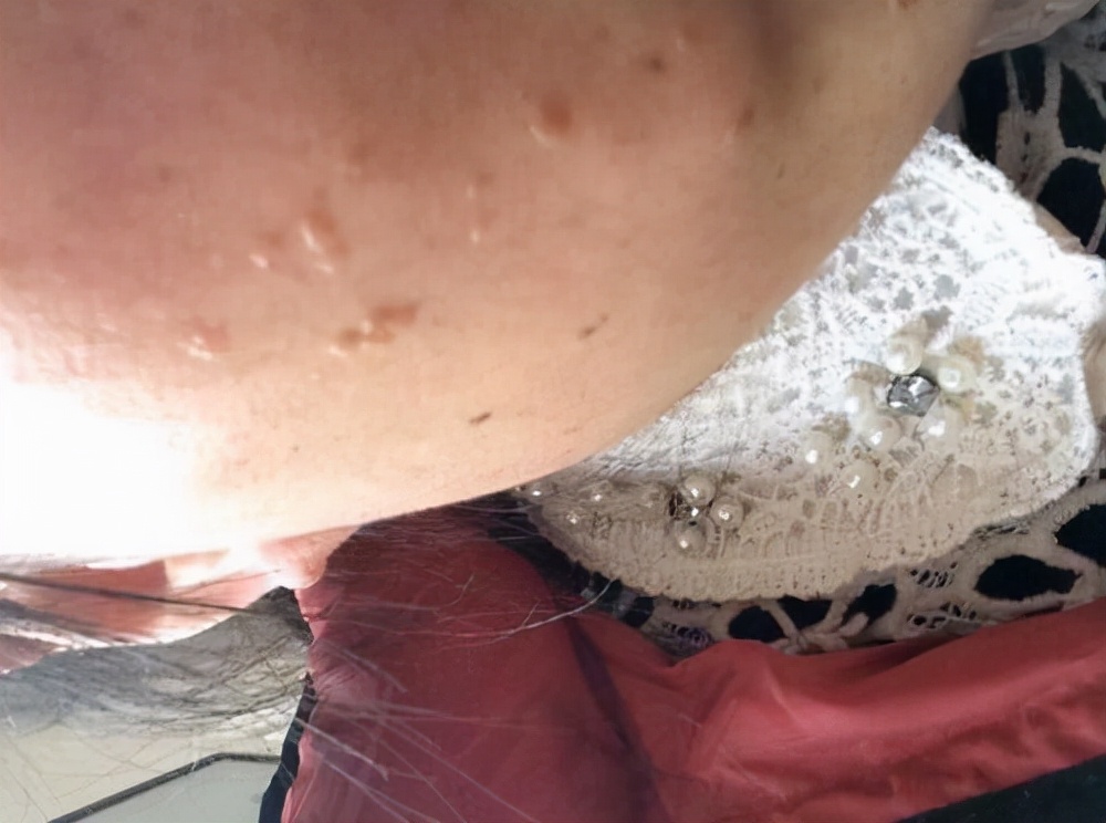 小杰啊啊 夫妻二人皆感染HPV，医生提示：身上这疙瘩要重视，或是HPV感染