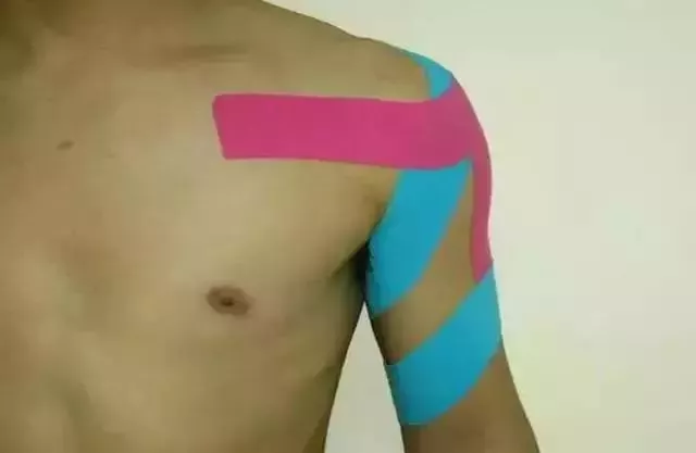 脑卒中|脑卒中肩关节半脱位的早期综合分析与康复治疗