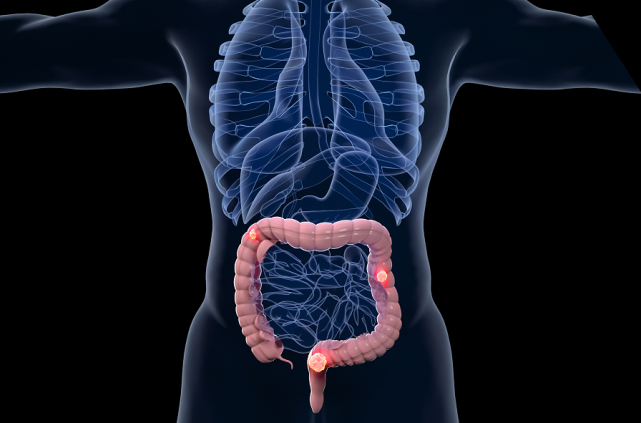 失眠|在家就能做的癌症筛查,家有中老年人的一定要试试!