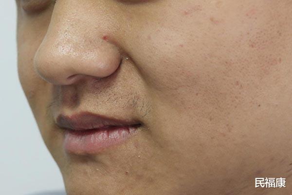 维生素b6|缺乏维生素B6的人，身上会有啥异常？不难看出来，你留意到了吗