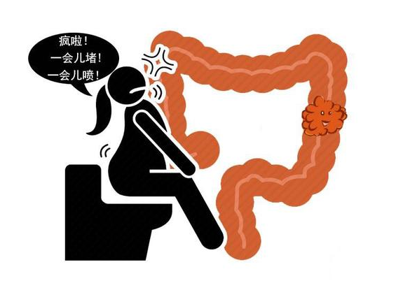 直肠癌|直肠癌早期为何难发现？医生道出真相，原来很多人都错了