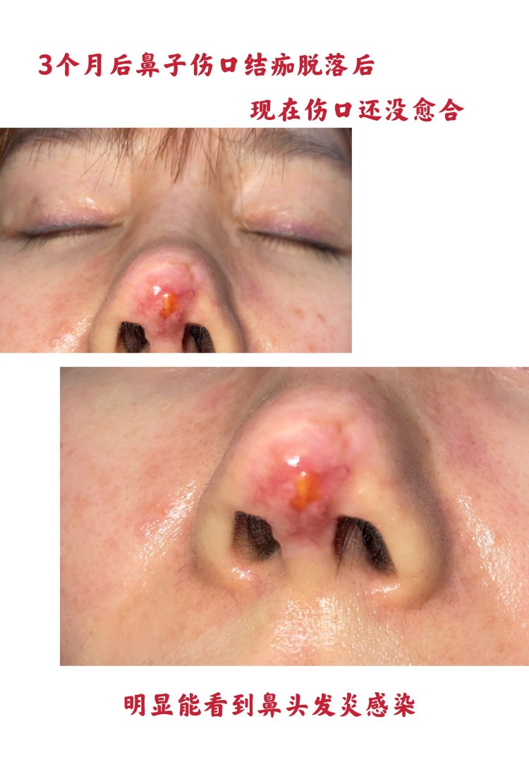 整容|演员高溜整容失败，鼻头坏死触目惊心，曾多次想自杀：整容需谨慎