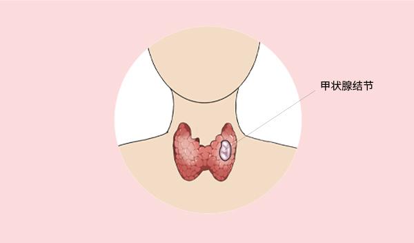 昧哥的快乐生活|甲状腺结节高发，担心出现癌变？医生澄清：甲状腺疾病没那么可怕