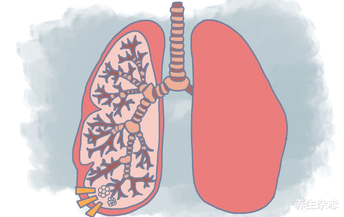 肺癌|无论男女，身体3处“疼痛”，或是肺脏“顶不住了”，趁早查查肺CT