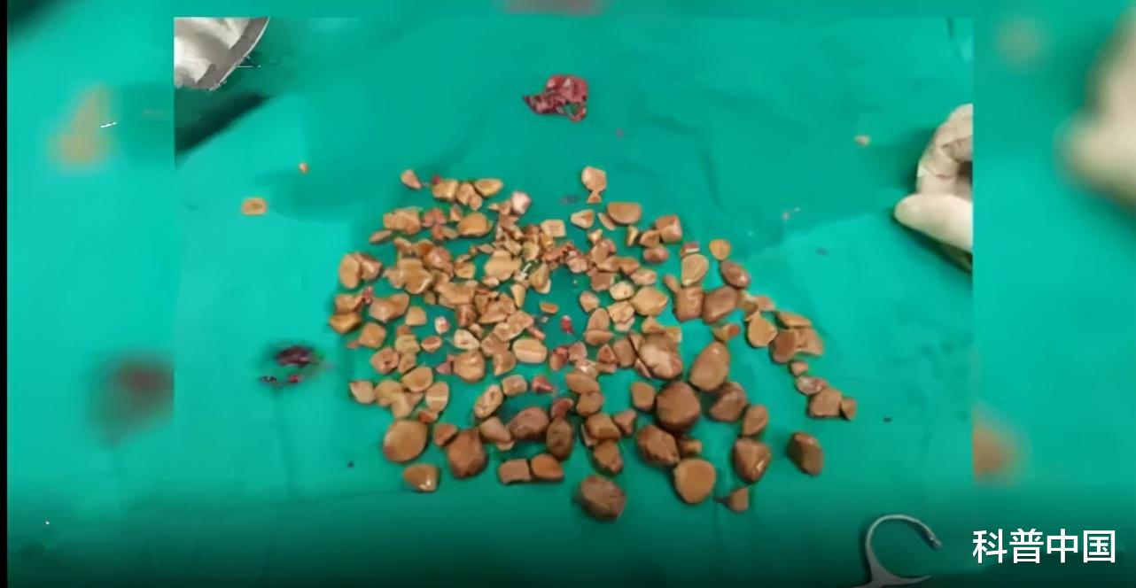 膀胱结石|膀胱里竟取出近200颗石子！男性更危险！都是这些习惯惹的祸