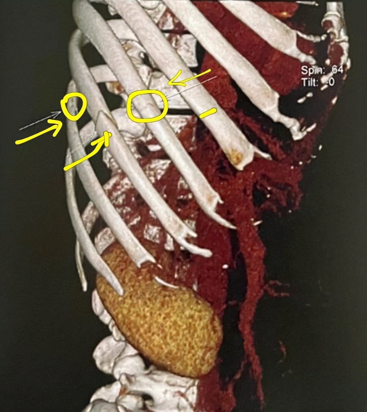 谭耀文|谭耀文回应拍戏受伤撞裂3根肋骨：当时痛到差点休克，仍坚持开工