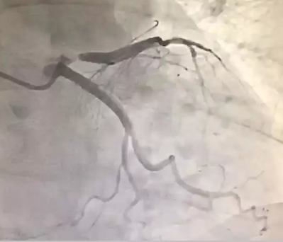 39奇妙的中医|耳朵上有这条折痕，是心梗、猝死的“标志”？专家: 不能划等号