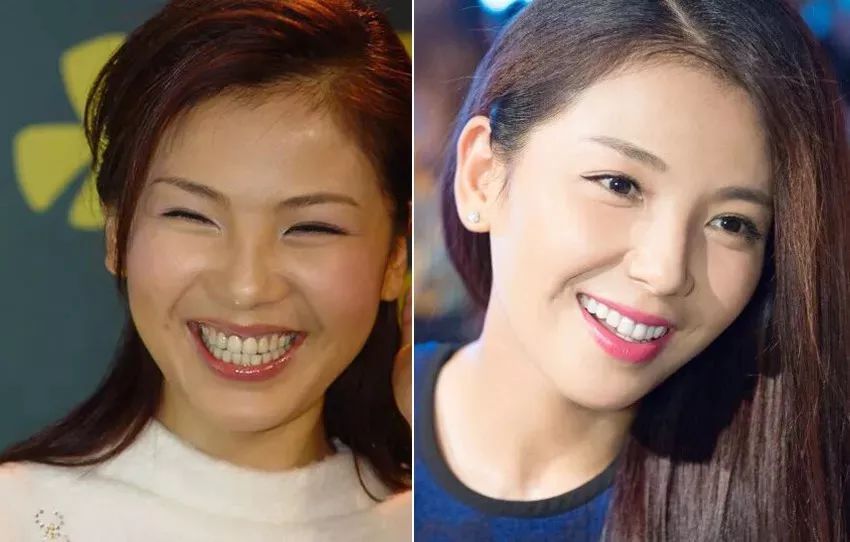 刘涛|这些明星做了烤瓷牙后，颜值反而下降了，连刘涛自己都后悔了！