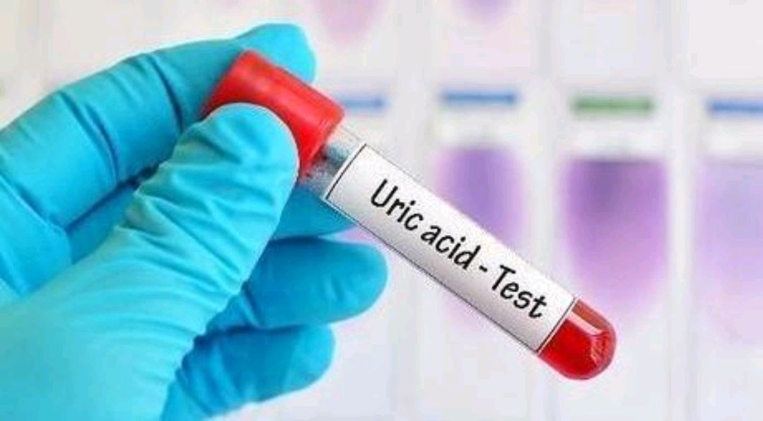 尿酸|查出了高尿酸，能吃“醋”吗？提醒：尿酸偏高，这5物尽量别碰