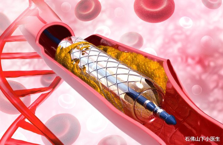 石佛山下小医生|冠心病支架术后就万事大吉了吗？有哪些需要注意的？