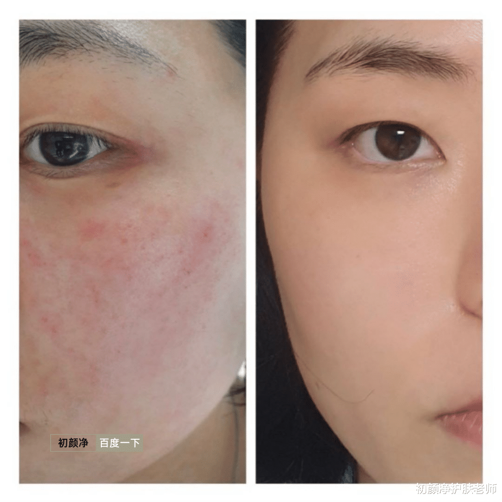 初颜净护肤老师 从源头改变痘肌体质!吃才是关键!