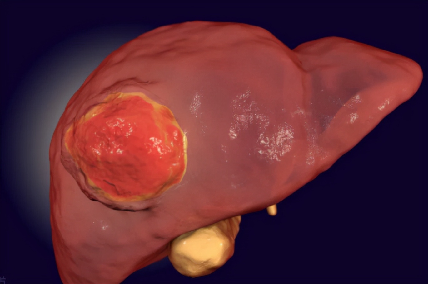 肝癌|妻子被丈夫一月25次“316”，确诊肝癌，医生惋惜：都是丈夫害了她