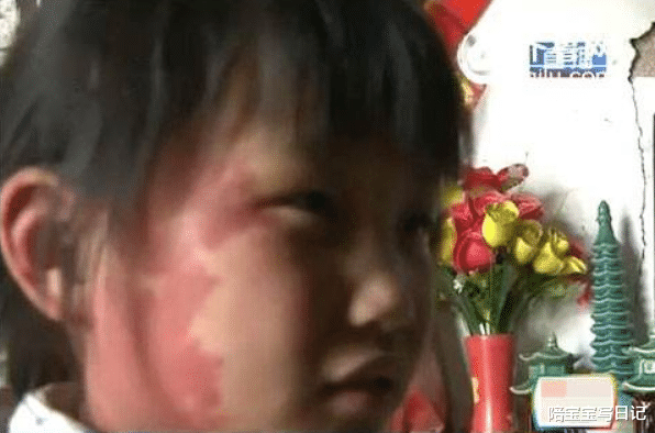 陪宝宝写日记|为什么宝宝总容易长胎记？产科医生：孕期尽量避免这3种行为