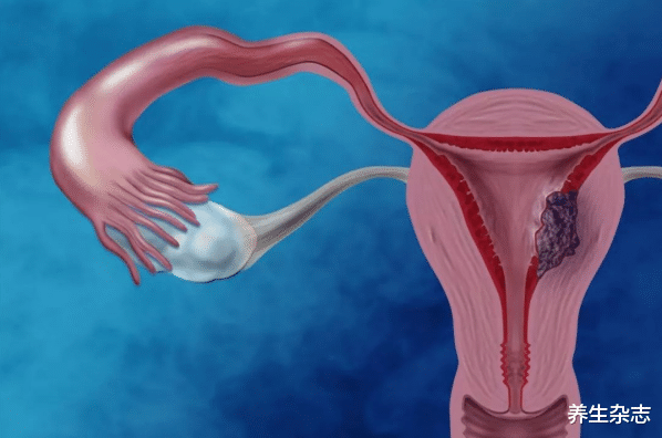 冠心病|鸡蛋是子宫肌瘤“发物”?医生:不想子宫“报废”,这3物及早撤下餐桌