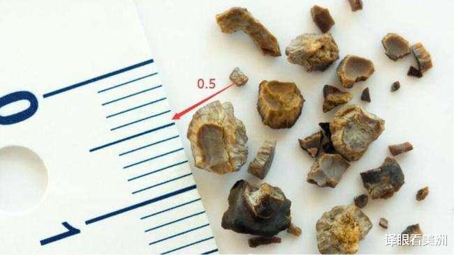 肾结石|156颗肾结石破纪录，50岁印度男子历经3小时取石手术