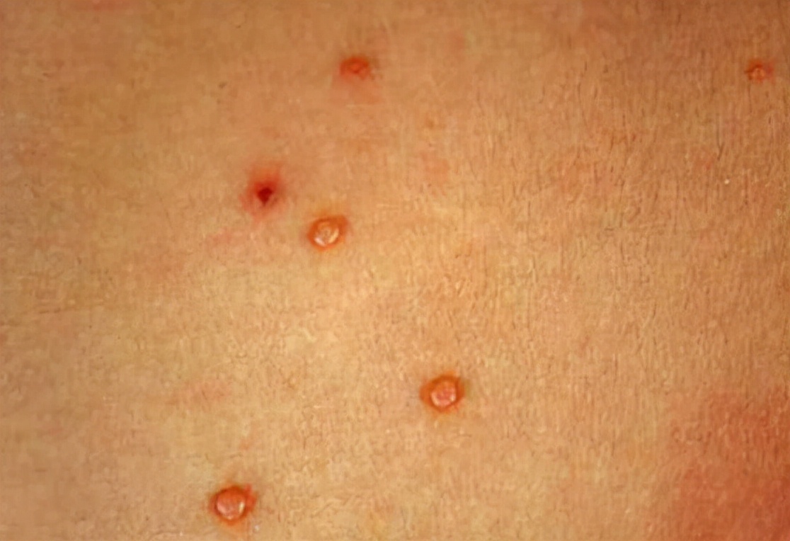 医生|18岁高中生感染HPV后长满疙瘩，父母怒斥不检点，医生：错怪孩子了