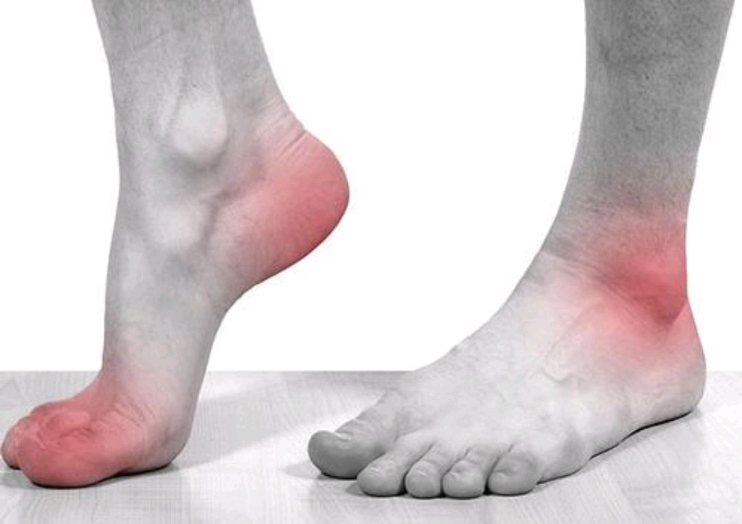 尿酸|“嘌呤大户”公布了,不只有海鲜,5种食物少吃,或能帮助降尿酸