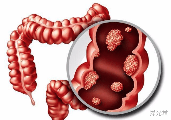 祥光堂|血糖高的人极易忽视的5个如厕细节,稍加了解,或能有助血糖平稳