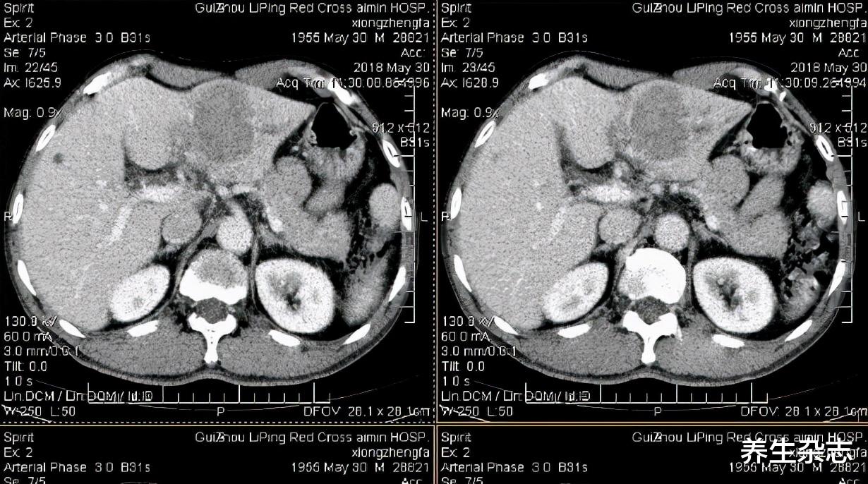 医生|41岁大姐身体乏力,半年后确诊肝癌,医生呵斥:1种蔬菜伤肝,白送也不要