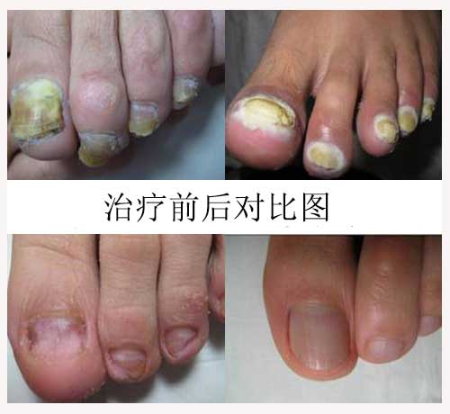 近视|灰指甲久治不愈怎么办？专家：每天一个自用小妙招，34天轻松康复！