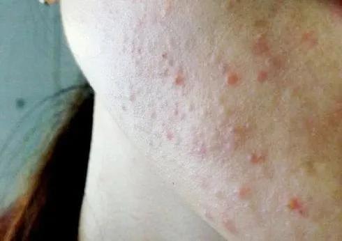 杏鲍菇|脸上很多小颗粒，咋回事？