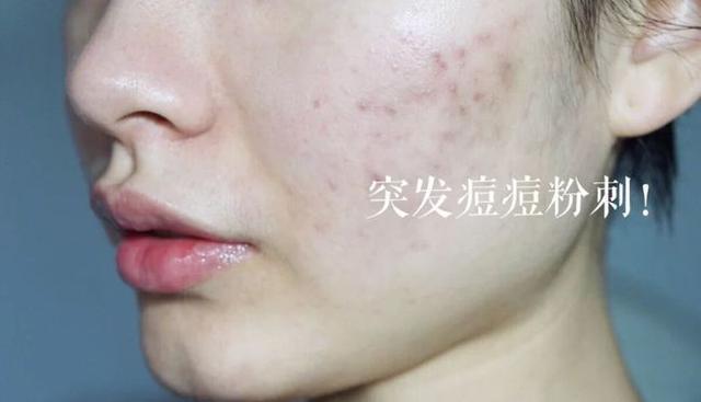 爽肤水 国内有一“憋屈”爽肤水，因“提成不高”导购很少推，其实很好用