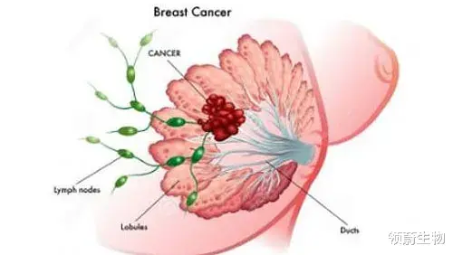 乳腺癌|乳腺癌术后放疗方案怎么选？记住这6点很关键