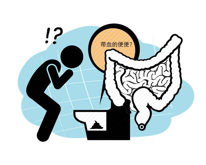 大肠癌|肠内有癌，大便告知？排便出现这3个迹象，提醒你尽早做一次肠检