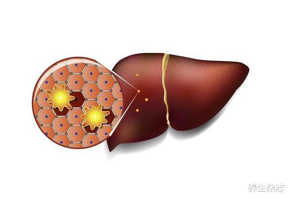 肝脏|身体出现4个“变化”，说明脂肪肝找上门，医生：3个小技巧，给你的肝穿上铠甲