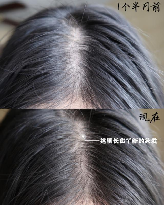 古力娜扎 娜扎从“脱发”恢复到“发量惊人”，分享的自用“生发法”火了，张馨予：靠谱国货