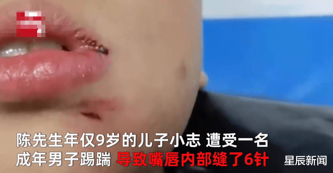 星辰新闻 福建9岁男孩打女童后，遭其父亲踹脸缝6针：希望叔叔能道歉