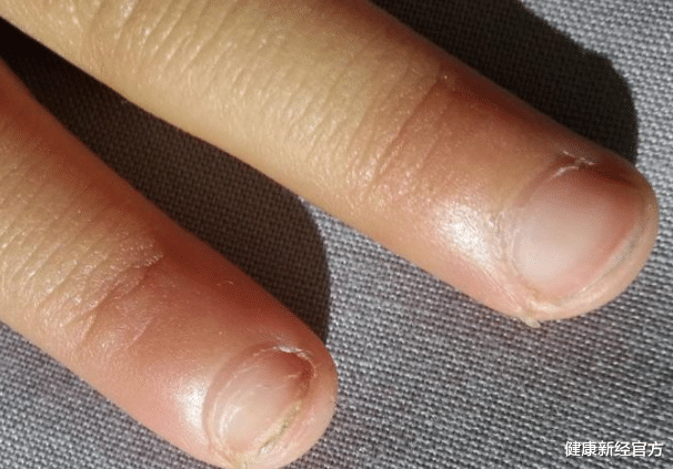 健康新经官方 指甲若有4种变化，八成是肝出问题了，哪怕占一个，也要及早检查