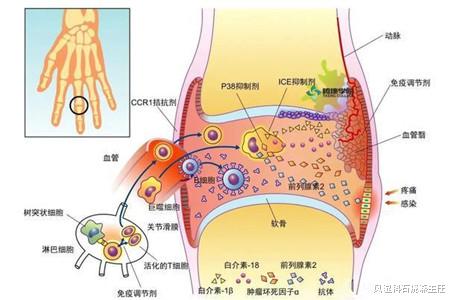 风湿科石晓燕主任|一些你可能不了解的类风湿特殊类型