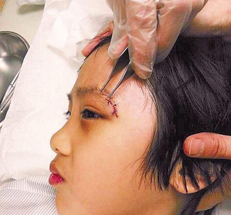 吴镇宇|吴镇宇儿子费曼近照：眼角疤痕仍触目惊心，当时气得怒摔话筒