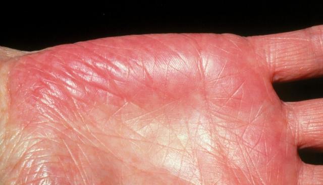 花生|手上若有3个“记号”，多半肝脏已硬化，提醒：护肝坚持3件事