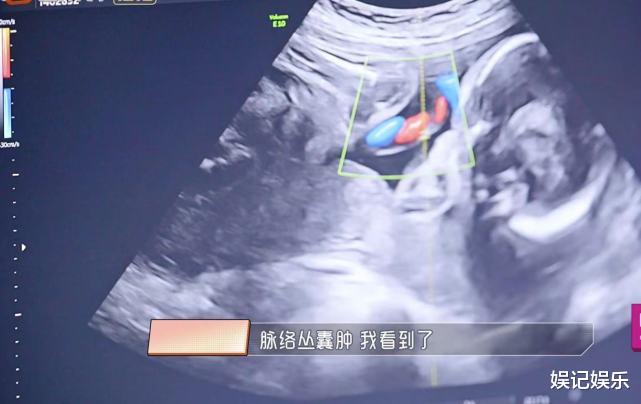 杜淳陪老婆產檢照曝光，王燦脈絡叢囊腫增大，擔心寶寶而痛哭-圖4