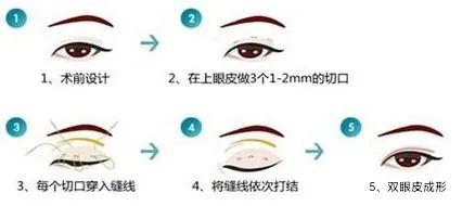 小美说美|妈生双眼皮怎么做