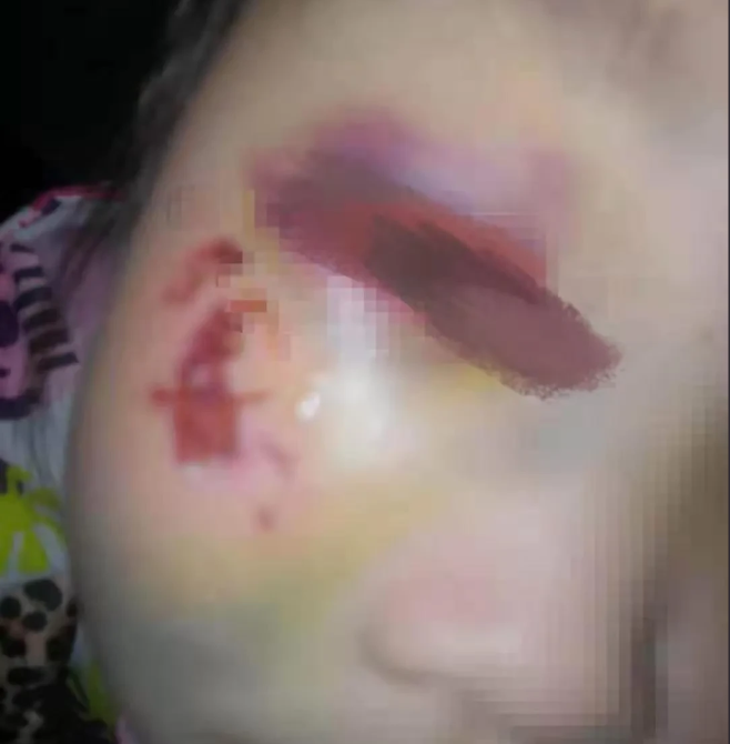 四面观察 8岁女孩做题少写一个单位,被数学老师暴打,眼睛险些失明