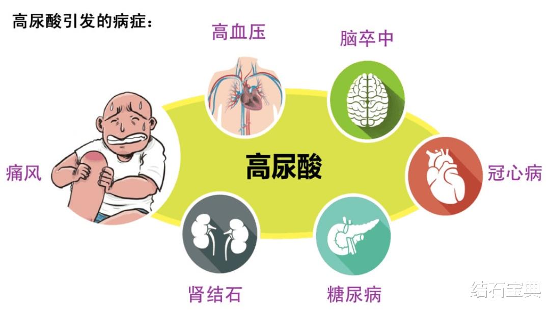 尿酸|尿酸结石的特点和治疗要点