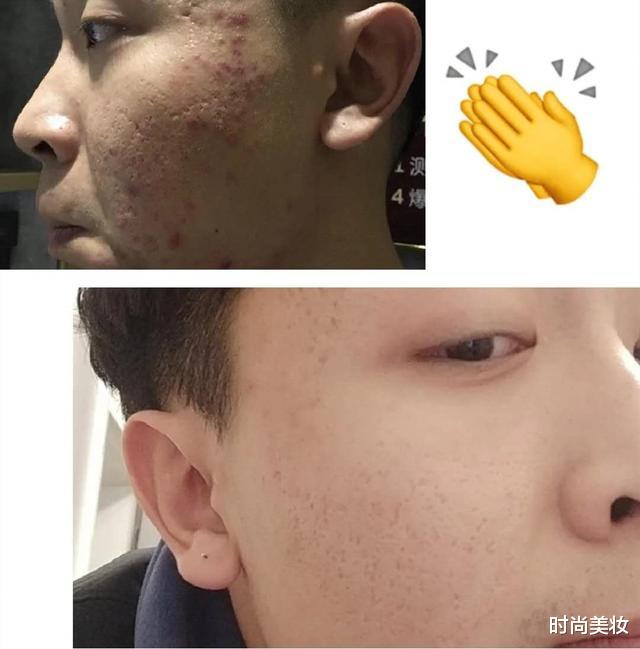 时尚美妆|刘亦菲也曾“跌下神坛”，只因后背长痘，长得好皮肤差是啥体验？