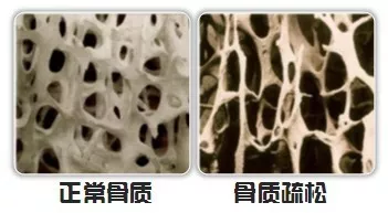 同基声 HIV感染者更容易骨质疏松，该如何预防