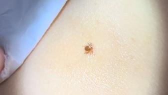 我是妈妈|4岁孩子被蜱虫咬伤，宝妈一番操作救了娃，获得医生连连称赞