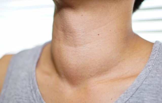 39健康网|甲状腺癌的“根源”被找到，烟酒未上榜，第一名我们天天吃