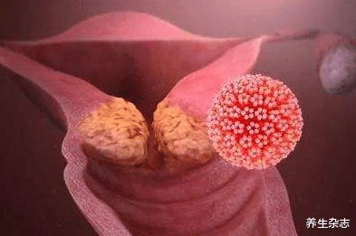 |女教师感染HPV，医生提醒：若感染HPV，身上会有3种迹象