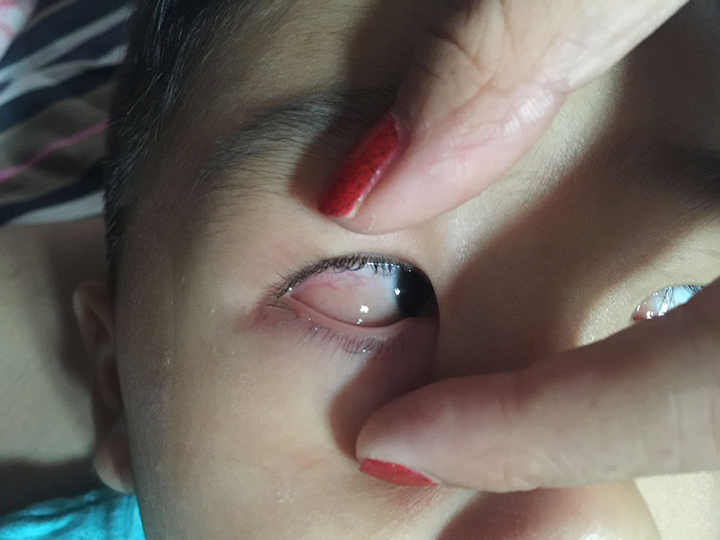 两口育儿|2岁女童眼睛里长3条白色小虫，妈妈告诫：一定要让孩子勤洗手