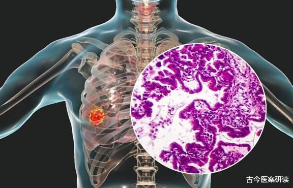 蔬菜|睡觉时,若有3种异常,很有可能是肺结节恶化,需及时调理