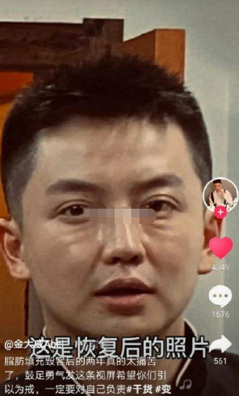 胡冰卿|网红金大威哭诉整容失败史，从鲜肉变大叔，到底是谁“毁”了他？